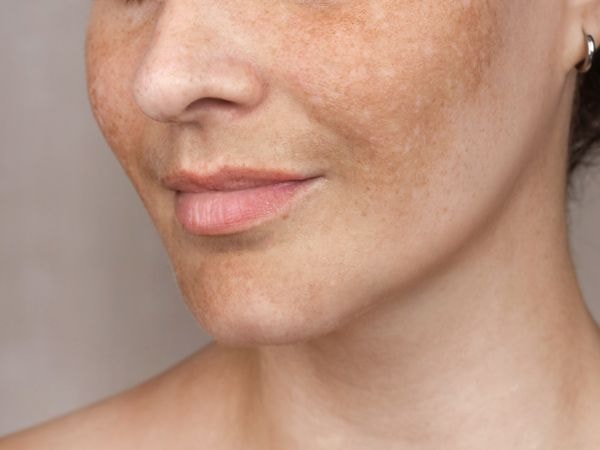 Mulher caucasiana com melasma e manchas escuras no rosto que podem ser evitadas com o uso de protetor solar.