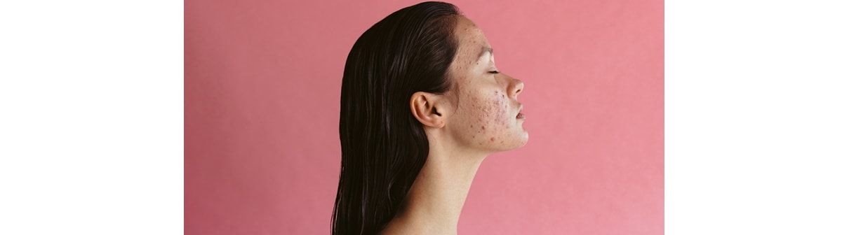 Acne adulto: como surge e como tratar?