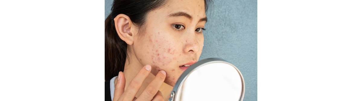 Saiba como identificar acne hormonal e por estresse