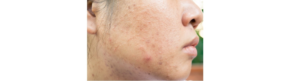 Veja o que causa e tratamentos de  cravos e espinhas gigantes