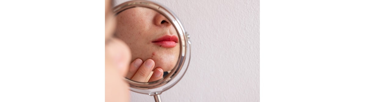 Espinha interna virou um caroço duro: veja como resolver 