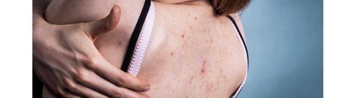 Espinhas nas costas: saiba quais as causas e como tratá-las | Garnier