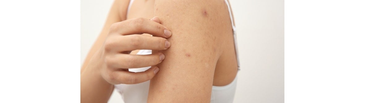 Mulher com espinhas no braço