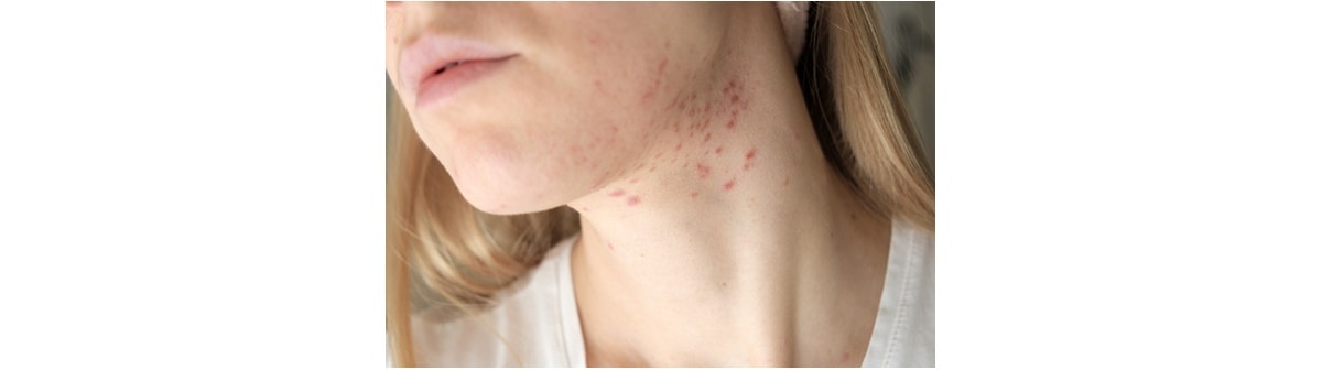 Espinha no pescoço: como surge e como secar?