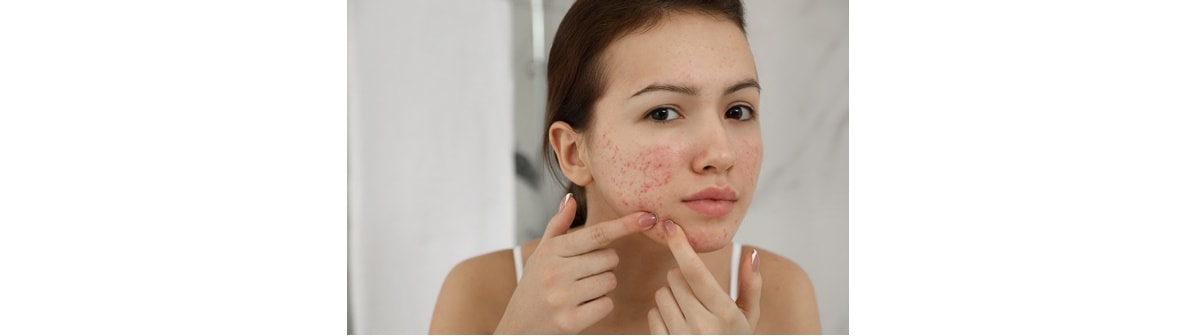 O que causa espinhas no rosto: Veja alguns motivos