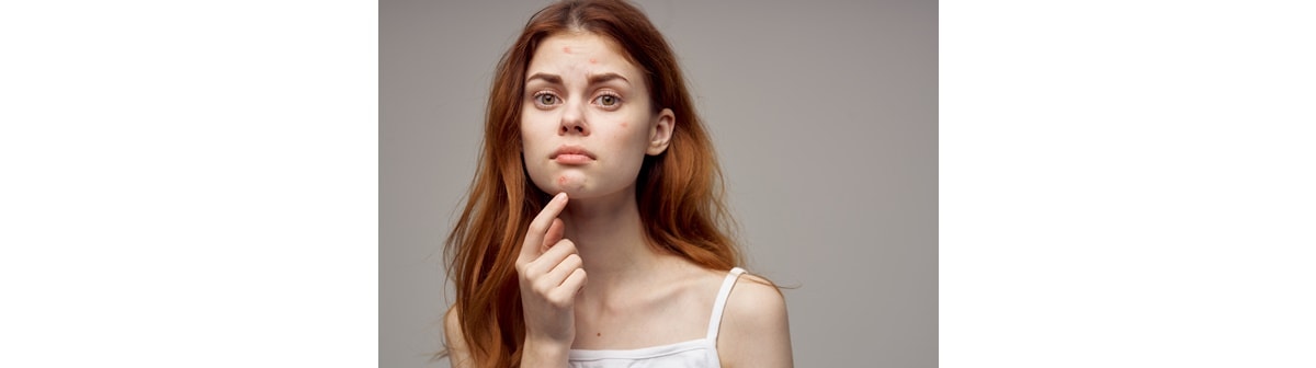 Saiba quais são as causas das espinhas no rosto