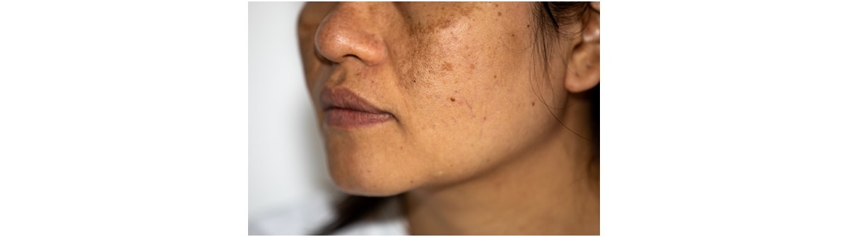 Manchas escuras na pele: dermatologista fala como cuidar