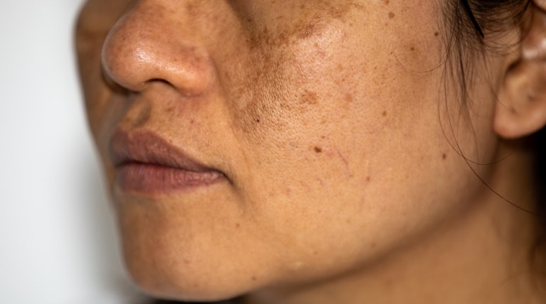 Manchas escuras na pele: dermatologista fala como cuidar