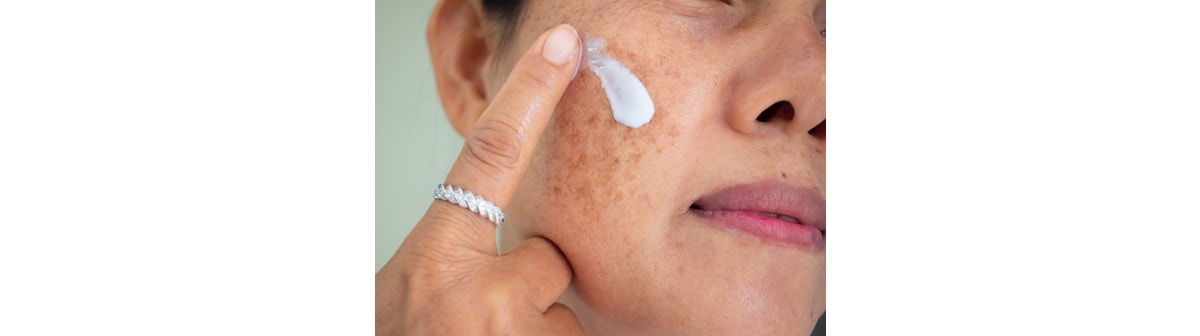 Manchas no corpo: quais são os tipos e como tratar?