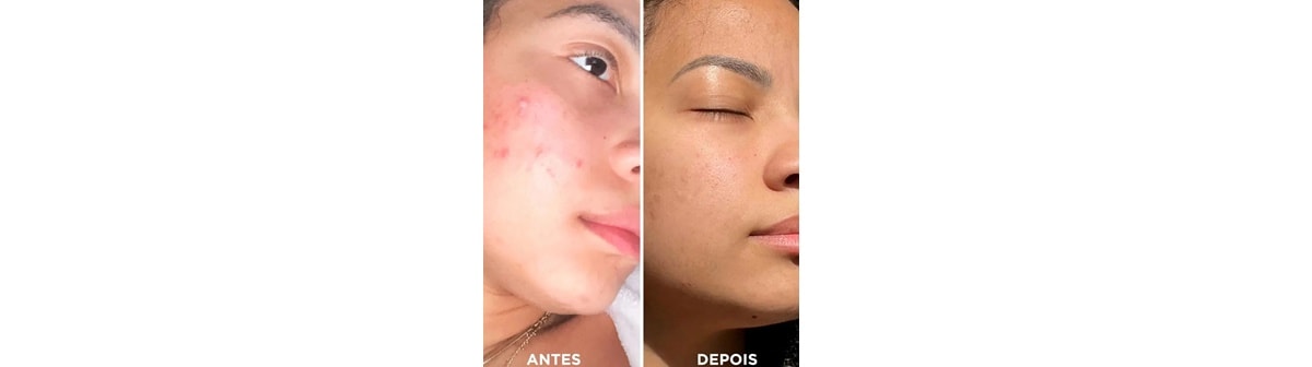 Manchas vermelhas na pele: saiba as possíveis causas dessas pequenas lesões. 