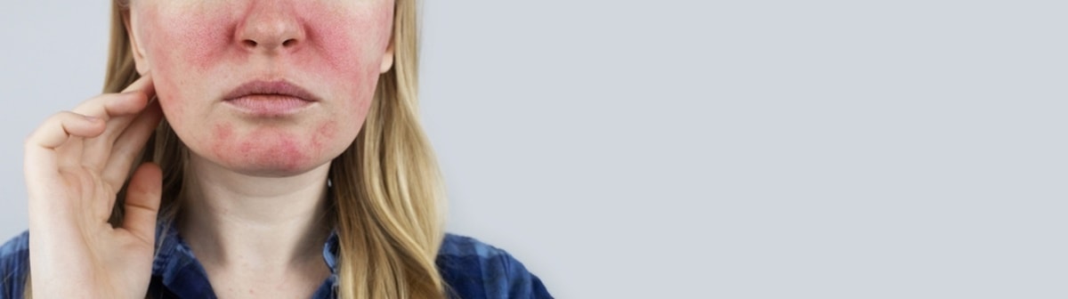 Rosácea: o que é, quais sintomas e como tratar?