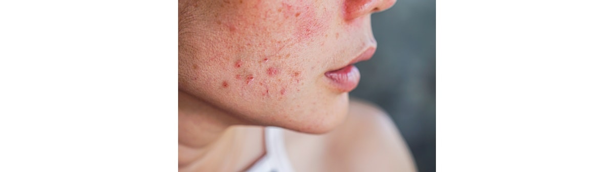 Rotina de skincare para pele com acne