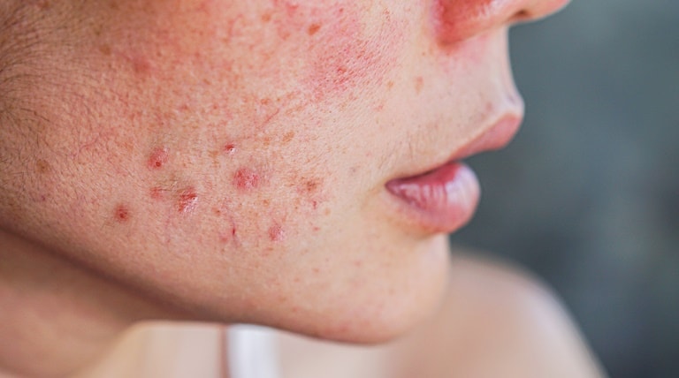Rotina de skincare para pele com acne