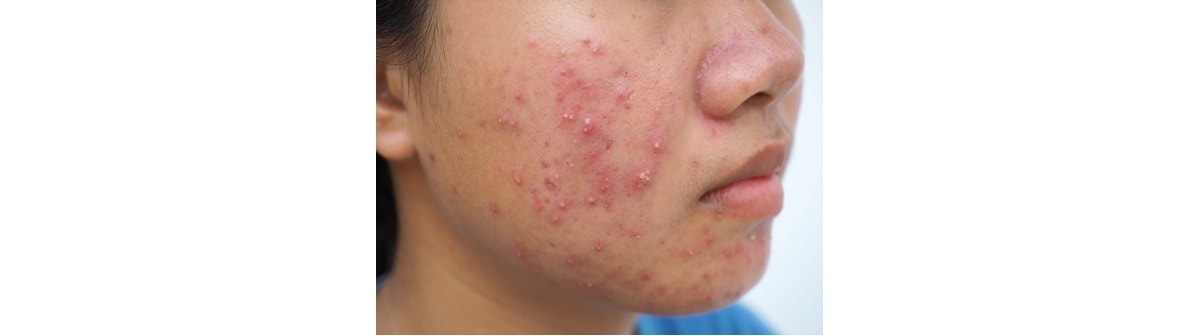 Rosto de uma garota com sintomas acne grau 2, como pústulas.