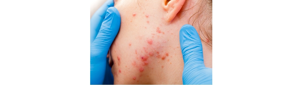 Dermatologista avalia pele facial com acne grau 3 ou acne nódulo-cística