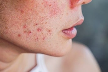 Mulher com pele acneica com rosto cheio de lesões inflamadas