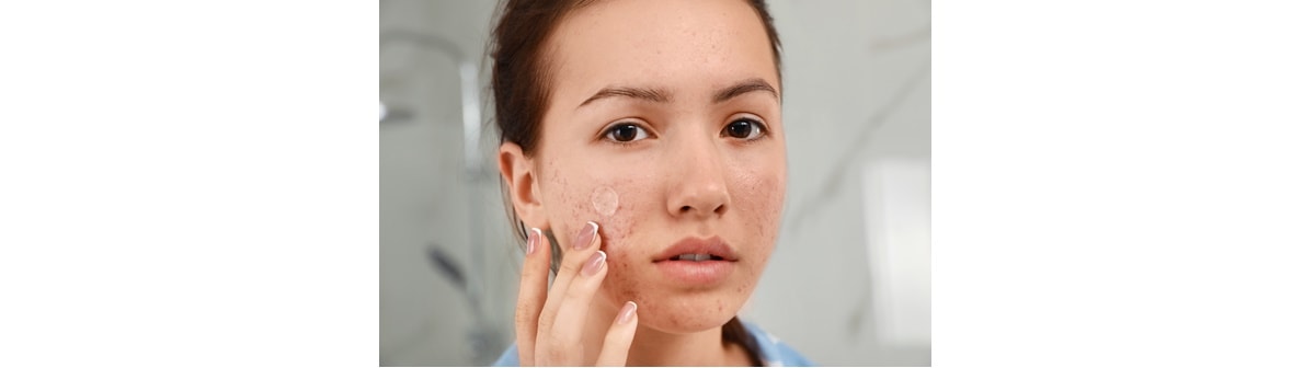 Jovem aplica adesivo para espinha em espinhas no rosto