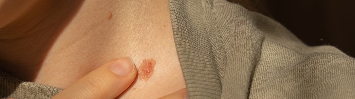 Veja como se proteger do câncer de pele