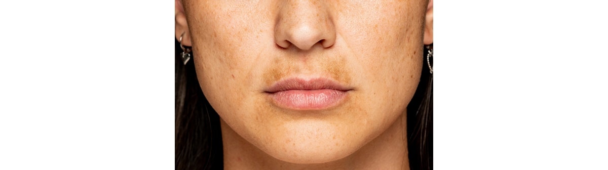 Pele facial com manchas que podem ser reduzidas com um clareador de pele