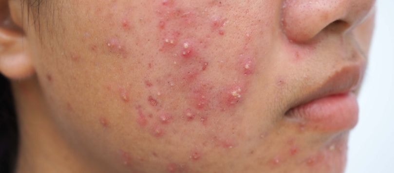 rosto de uma pessoa com pele morena, mostrando a bochecha com múltiplas espinhas inflamadas e cravos na região.