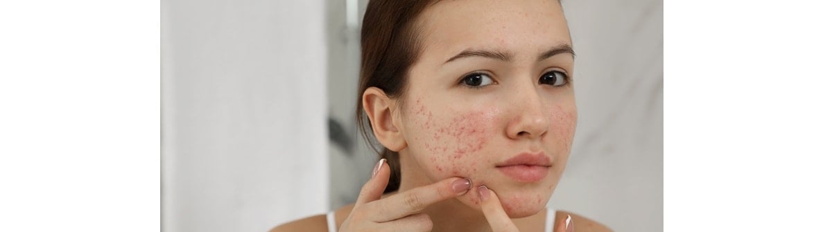 Menina adolescente espreme cravos e espinhas em casa