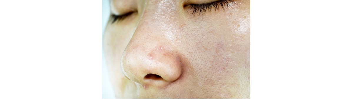 Cravos como identificá-los na pele