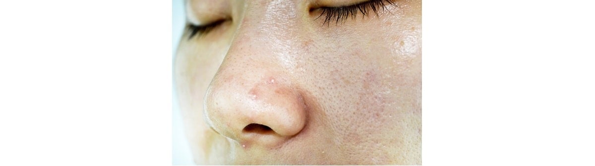 Cravos como identificá-los na pele