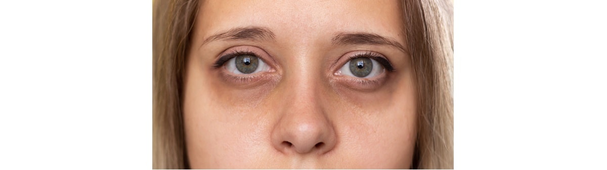 Olhos de uma mulher caucasiana com olheiras que podem ser tratadas com um creme para olheiras.