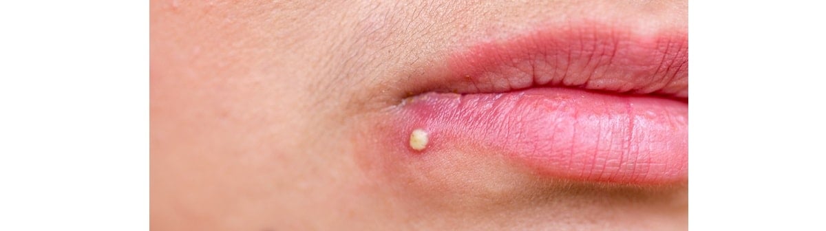 espinha ou acne na boca