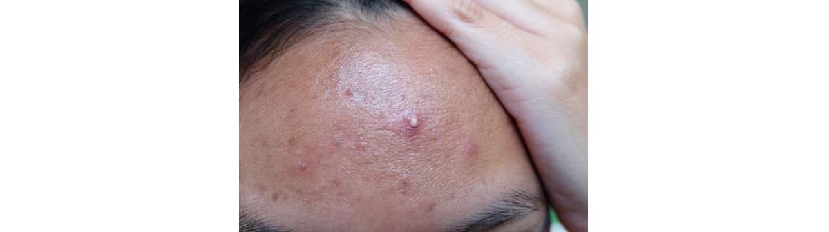 Indivíduo com espinha na testa e acne inflamada na testa