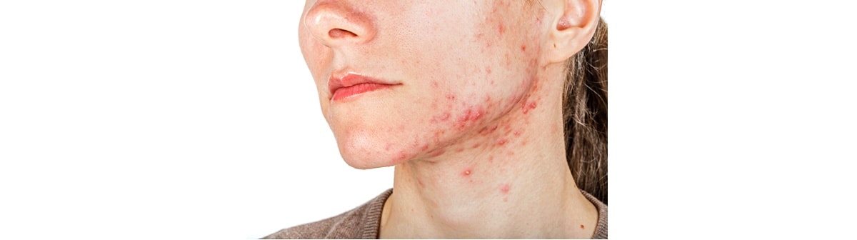 mulher com rosto com lesões de foliculite