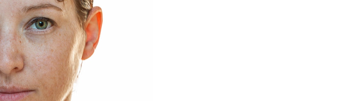 Manchas no sol na pele causadas por exposição aos raios solares