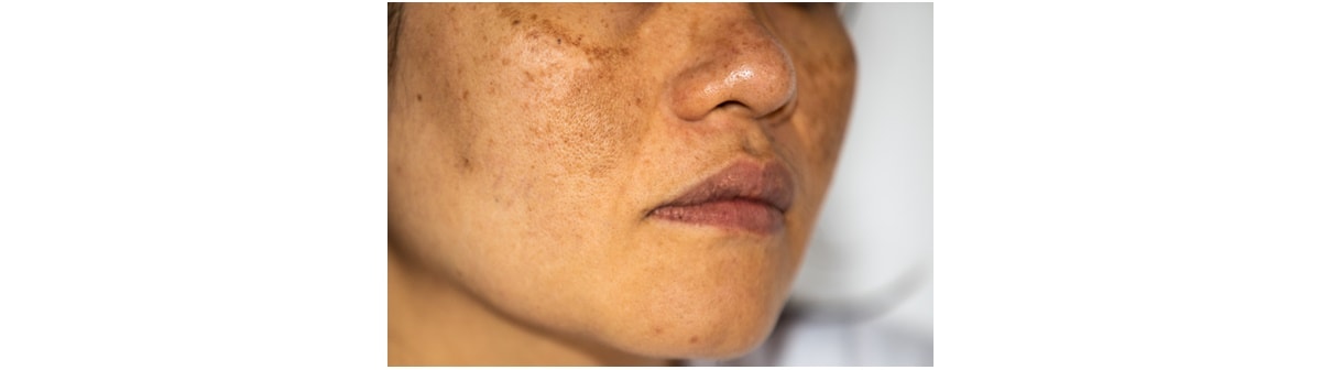 Mulher de pele amarela com manchas na pele