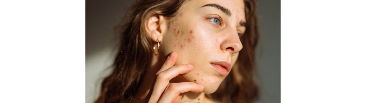 Mulher jovem apresenta sintomas no rosto da pele acneica