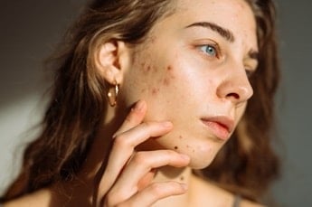 Mulher jovem apresenta sintomas no rosto da pele acneica