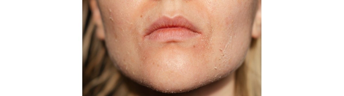 Pele descamando saiba como tratar