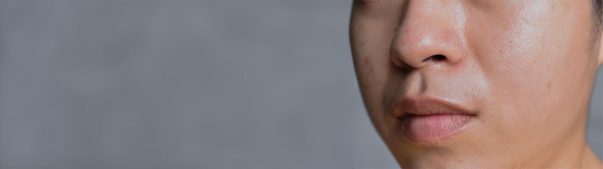 Pele mista conheça mais sobre esse tipo de pele