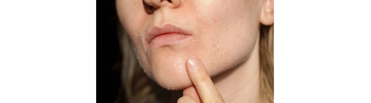 Mulher caucasiana aponta para seu rosto com a pele ressecada