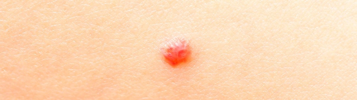 Pinta vermelha, nevo rubi, angioma cereja ou angioma senil na pele