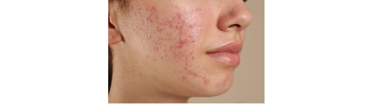 Jovem mulher com acne no rosto que pode ser tratada com sérum antiacne ou pomada para acne