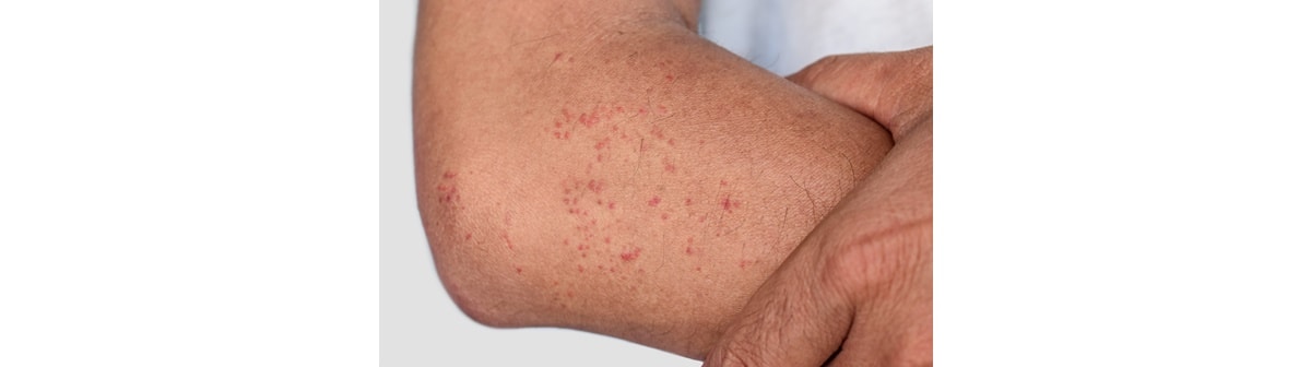 Pontos vermelhos na pele do braço de um homem