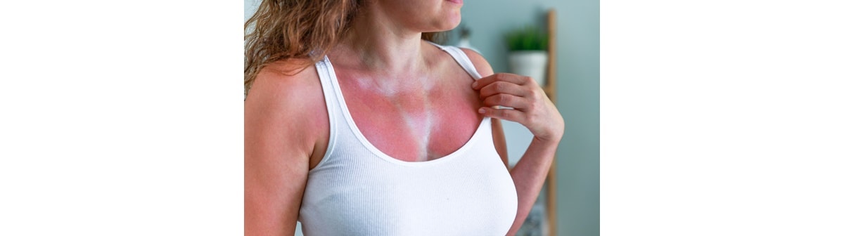 Mulher apresenta queimadura de sol em sua pele vermelha e irritada