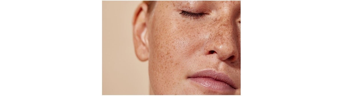 Mulher de pele clara de olho fechado e com sardas no rosto