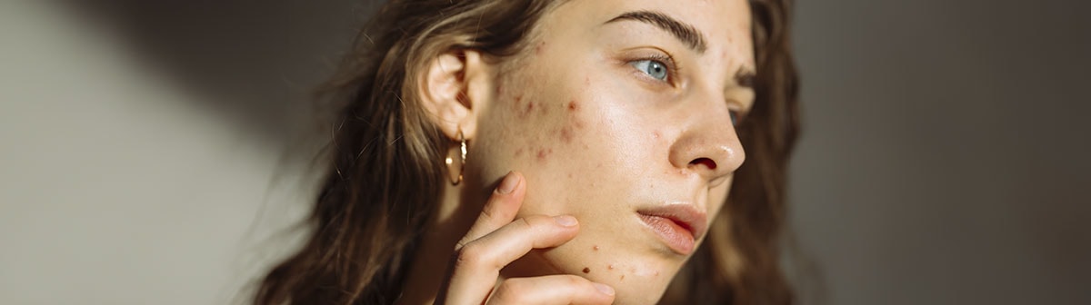 Mulher jovem com pele acneica que pode ser tratada através do uso da vitamina c para a pele com