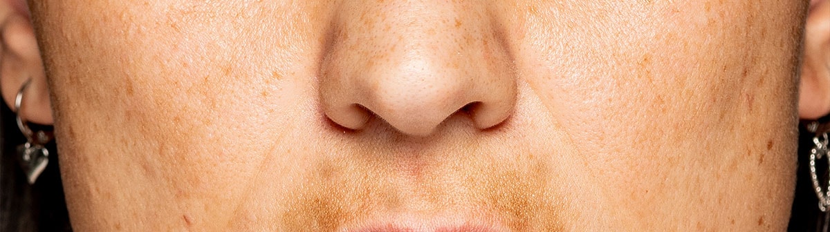 mulher de pele amarela com manchas na região do buço