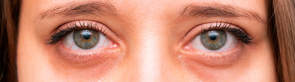 mulher de pele clara com olhos verdes com olheiras