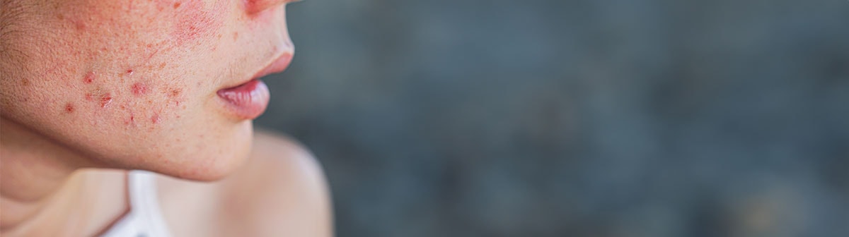 mulher de pele clara com lesões de acne na face