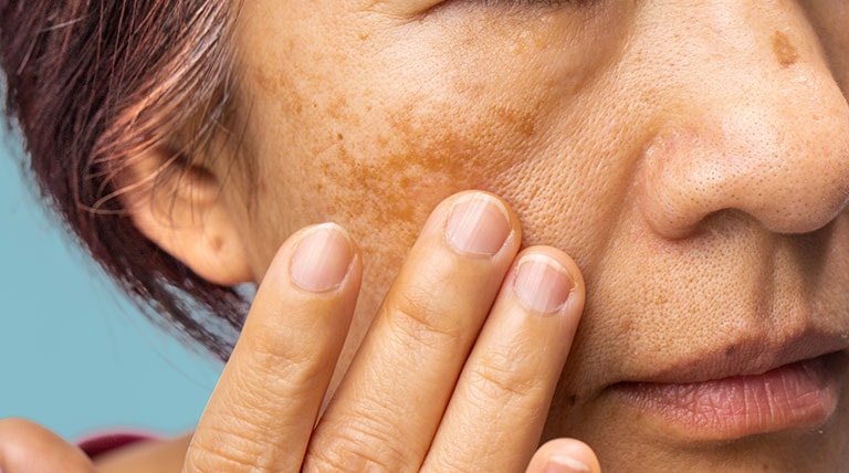 mulher de pele amarela de meia idade com manchas de melasma no rosto