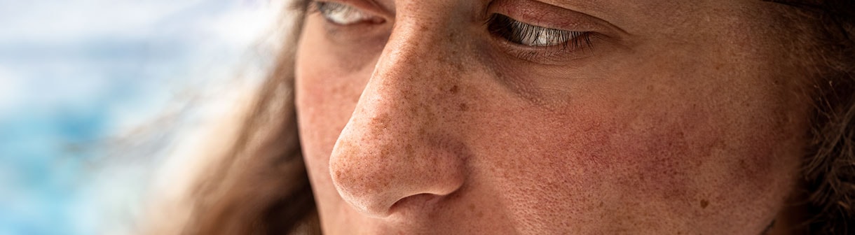 Mulher branca com manchas de sol no rosto