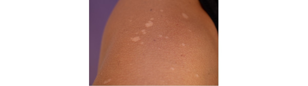 Manchas brancas na pele: veja como surge e tratamentos